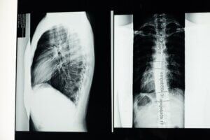X-Ray Images of the Spine